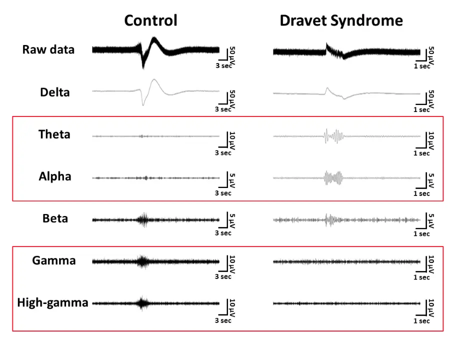 Brain Wave Abnormalities in Dravet Syndrome Patient-Derived Organoids